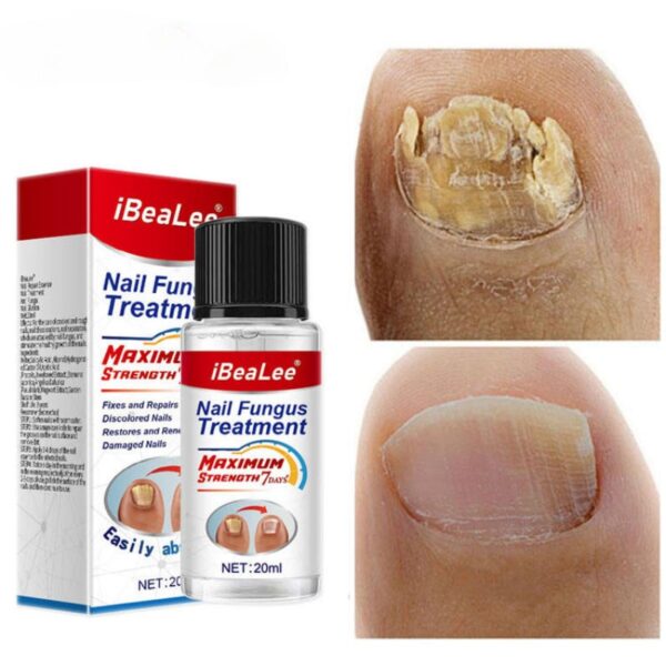 For Nail Fungal Treatment Feet Care Essence Extra Strong Nails Repair Foot Toe Nail Fungus Removal Gel Beauty Health Care - Image 8